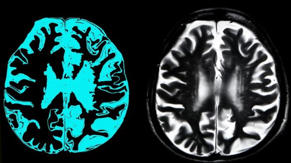 Primul medicament care poate încetini evoluția bolii Alzheimer